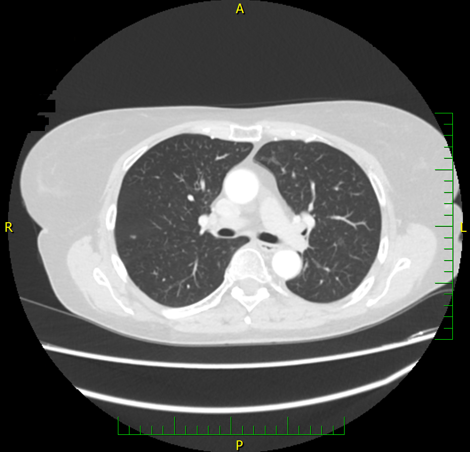 Restagingové CT hrudníku